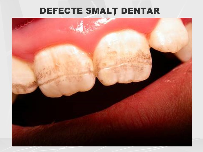 DEFECTE SMALȚ DENTAR